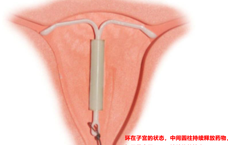节育环工作原理.png